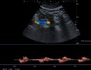 AORTA 2