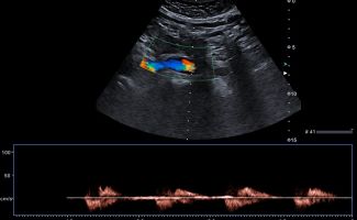 AORTA 2