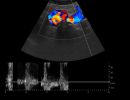 AORTA 3