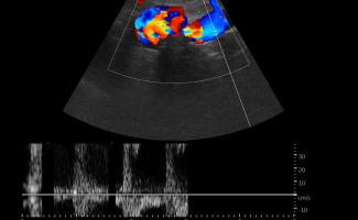 AORTA 3