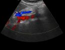 AORTA 4