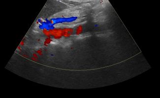 AORTA 4