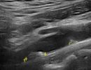 CAROTID 1