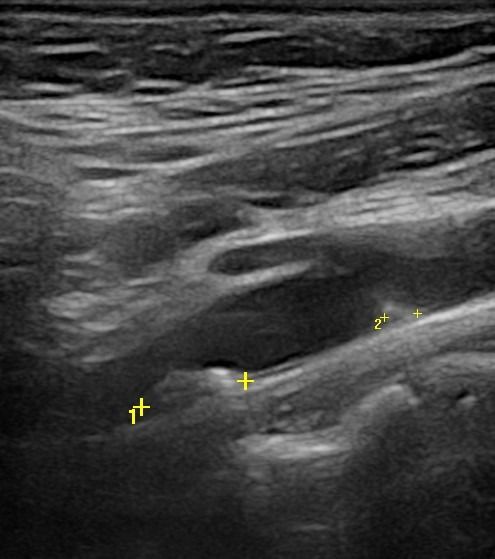 CAROTID 1