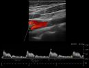 CAROTID 2