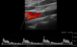 CAROTID 2