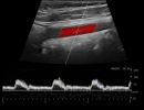 CAROTID 3