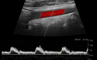 CAROTID 3