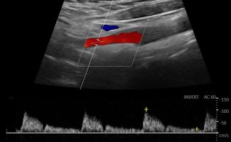 CAROTID 4