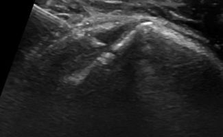 1  PRP SHOULDER