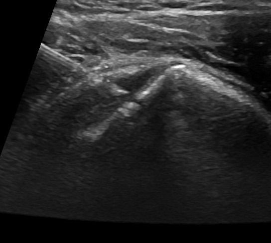 1  PRP SHOULDER