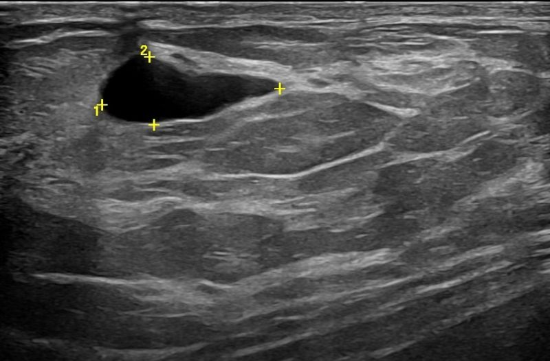 BREAST 1