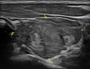 THYROID 4
