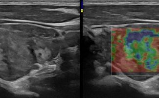 THYROID 6
